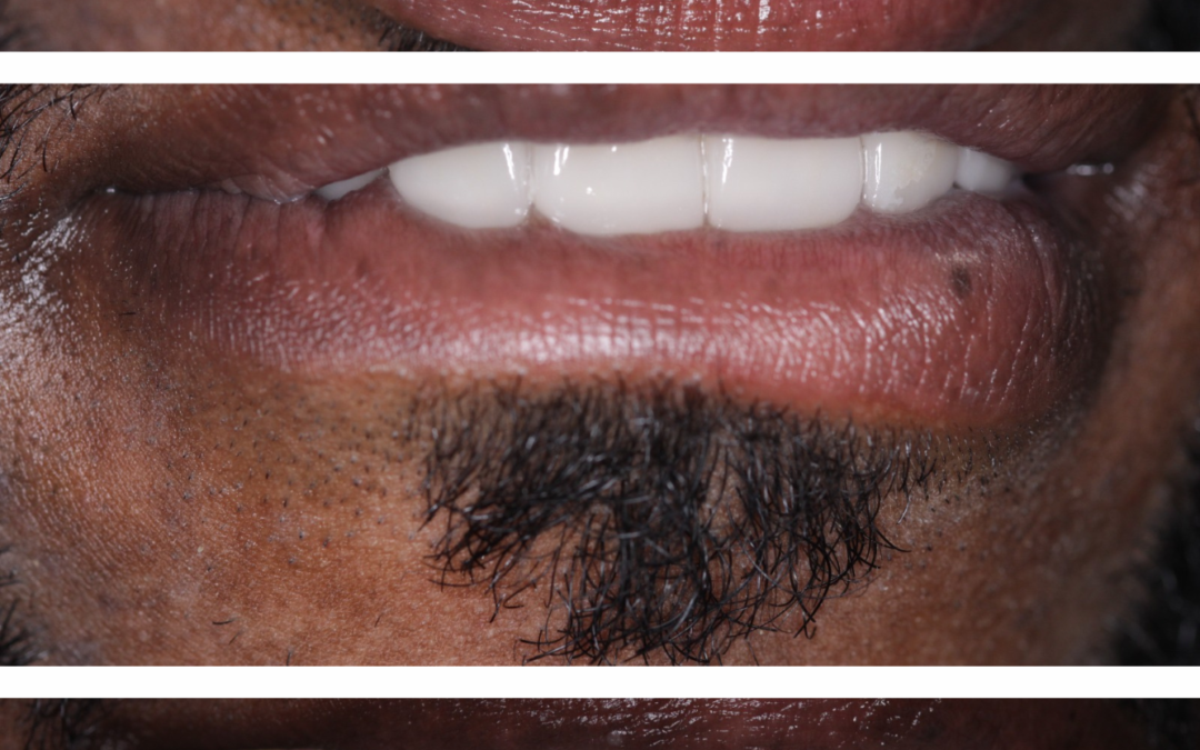 Estética dental — Caso 1