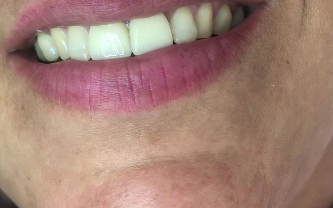 Estética dental — Caso 2