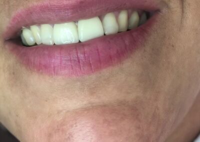 Estética dental — Caso 2 Sonrisa de la paciente después del tratamiento de estética dental en la Clínica Dr. Ramsés Gonell