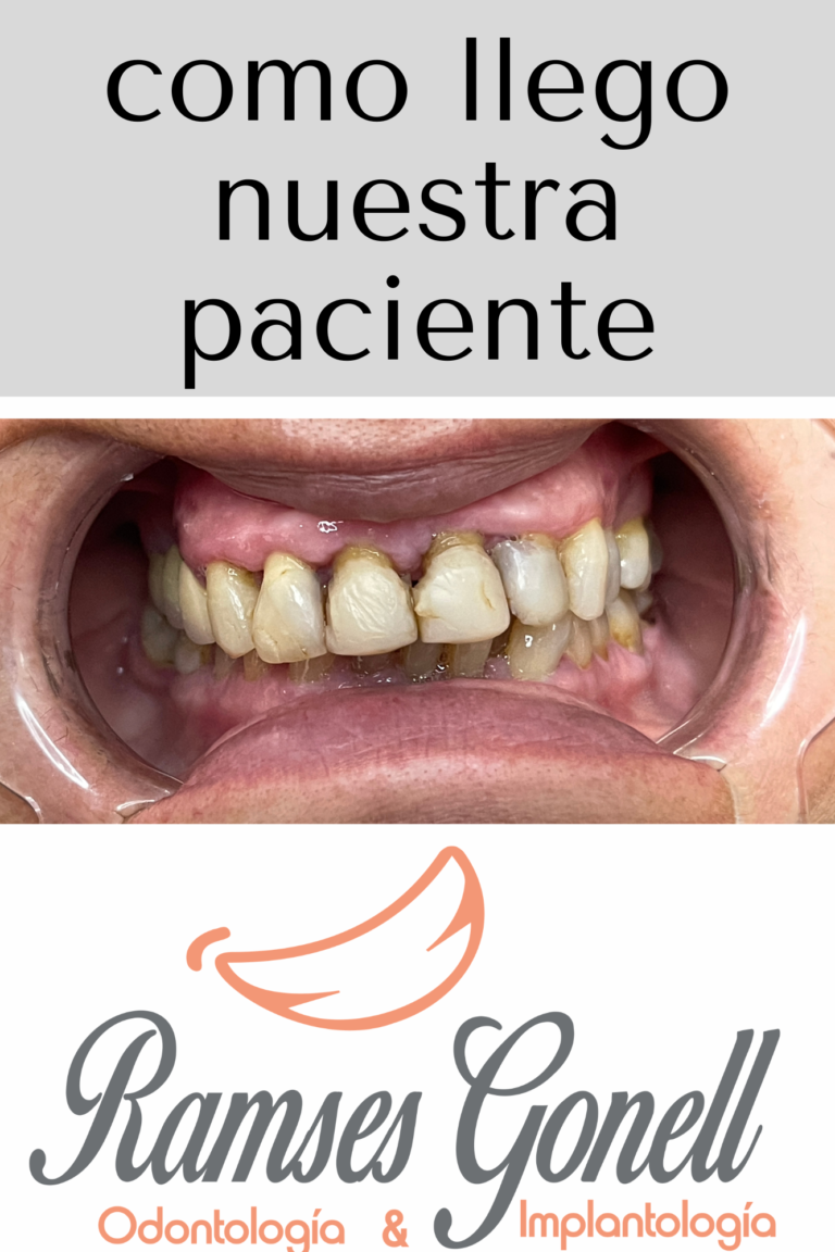 Sonrisa de la paciente antes del tratamiento de estetica dental en la clinica del Dr. Ramses Gonell en Santiago