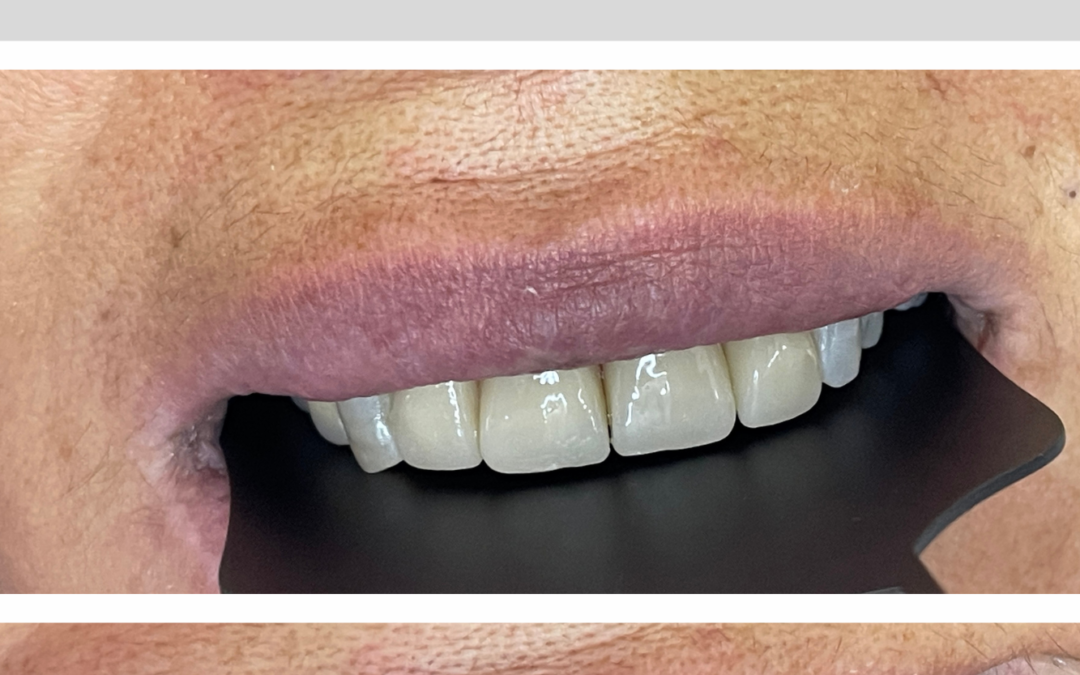 Estética dental — Caso 3
