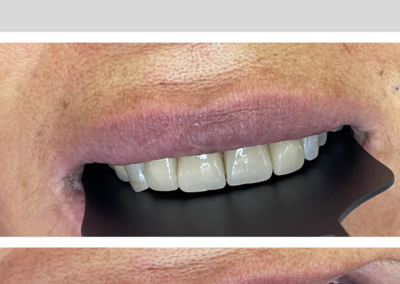 Estética dental — Caso 3
