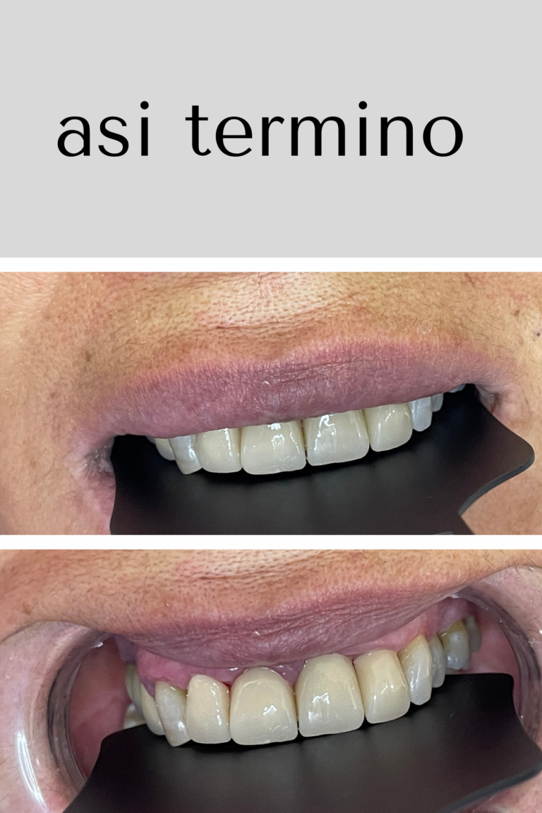Sonrisa de la paciente despues del tratamiento de estetica dental en la clinica del Dr. Ramses Gonell en Santiago