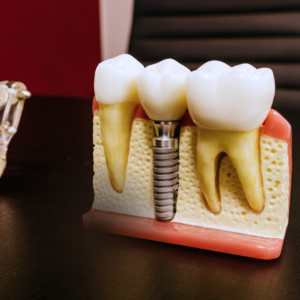 Modelo anatómico de un implante dental de titanio integrado en el hueso, entre dos dientes naturales