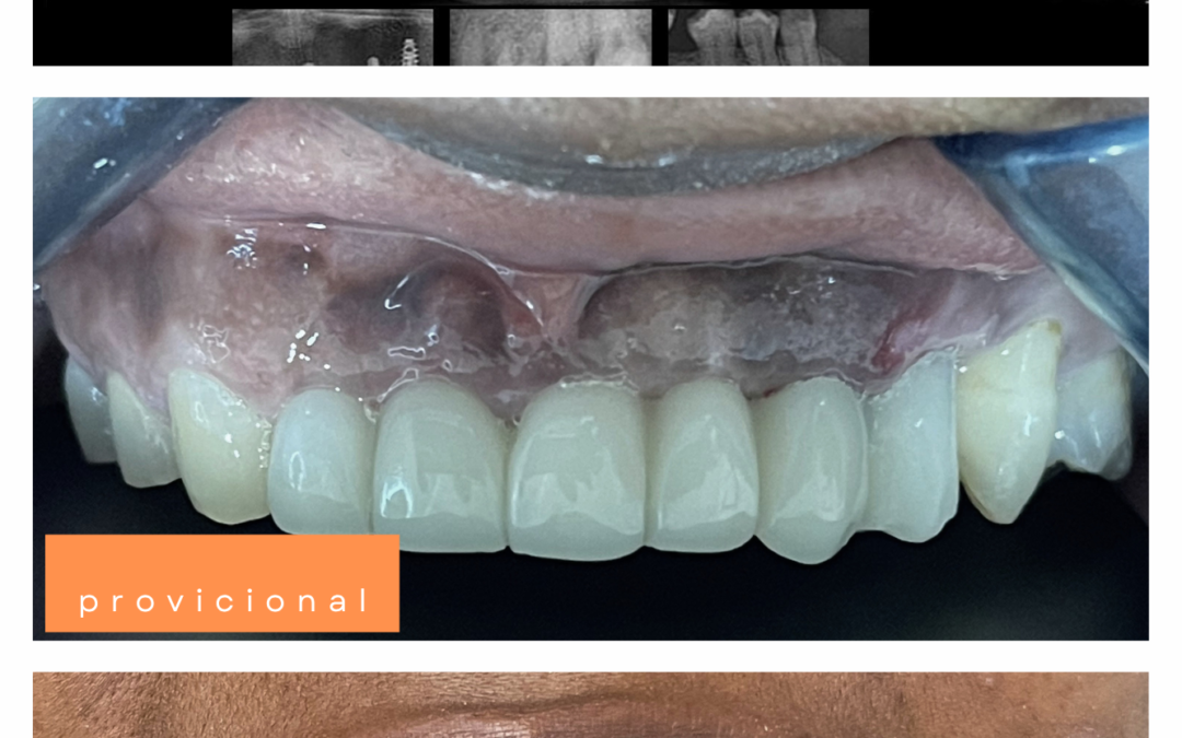 Implantes dentales — Caso 1