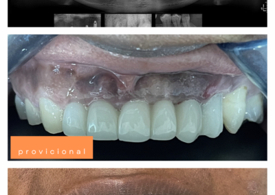 Implantes dentales — Caso 1