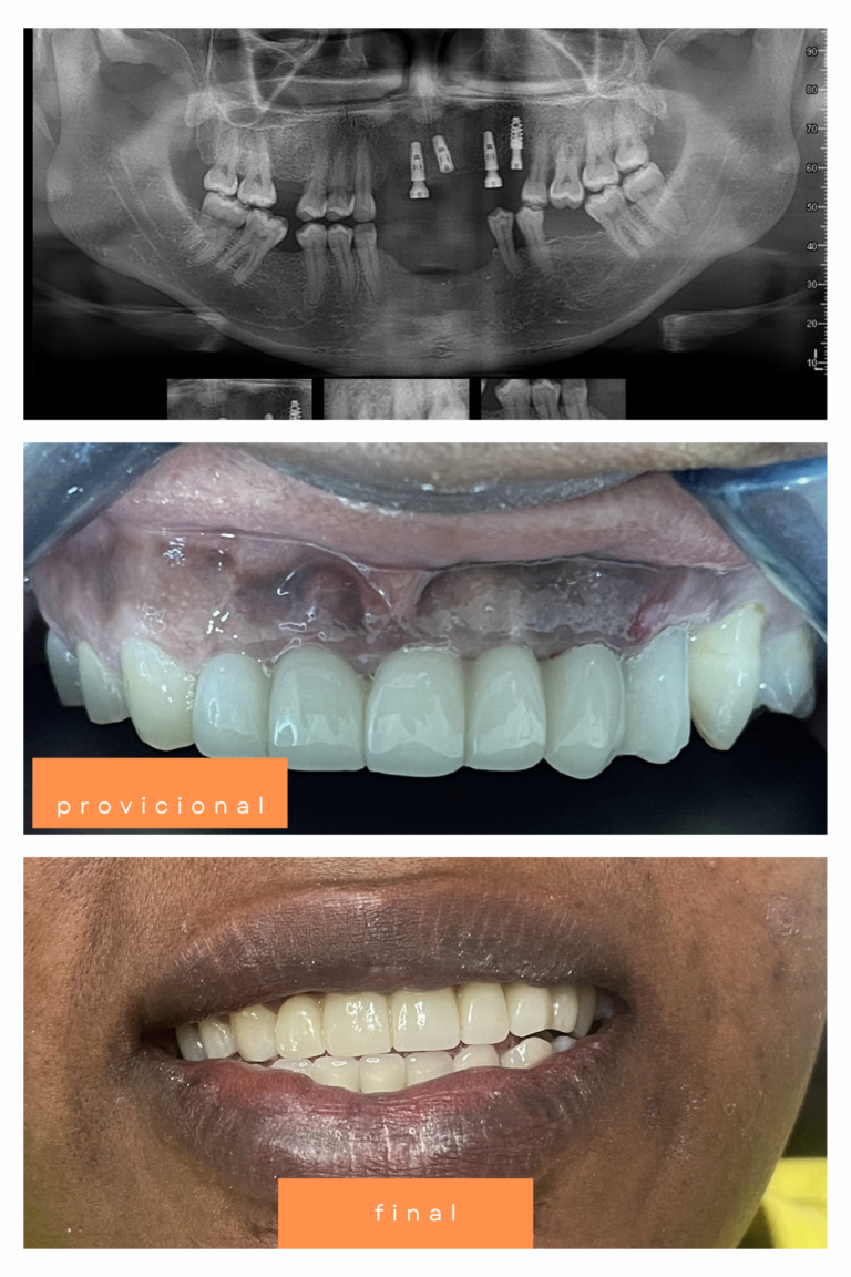 Radiografia de planificacion, protesis provisional y resultado final del tratamiento con implantes dentales