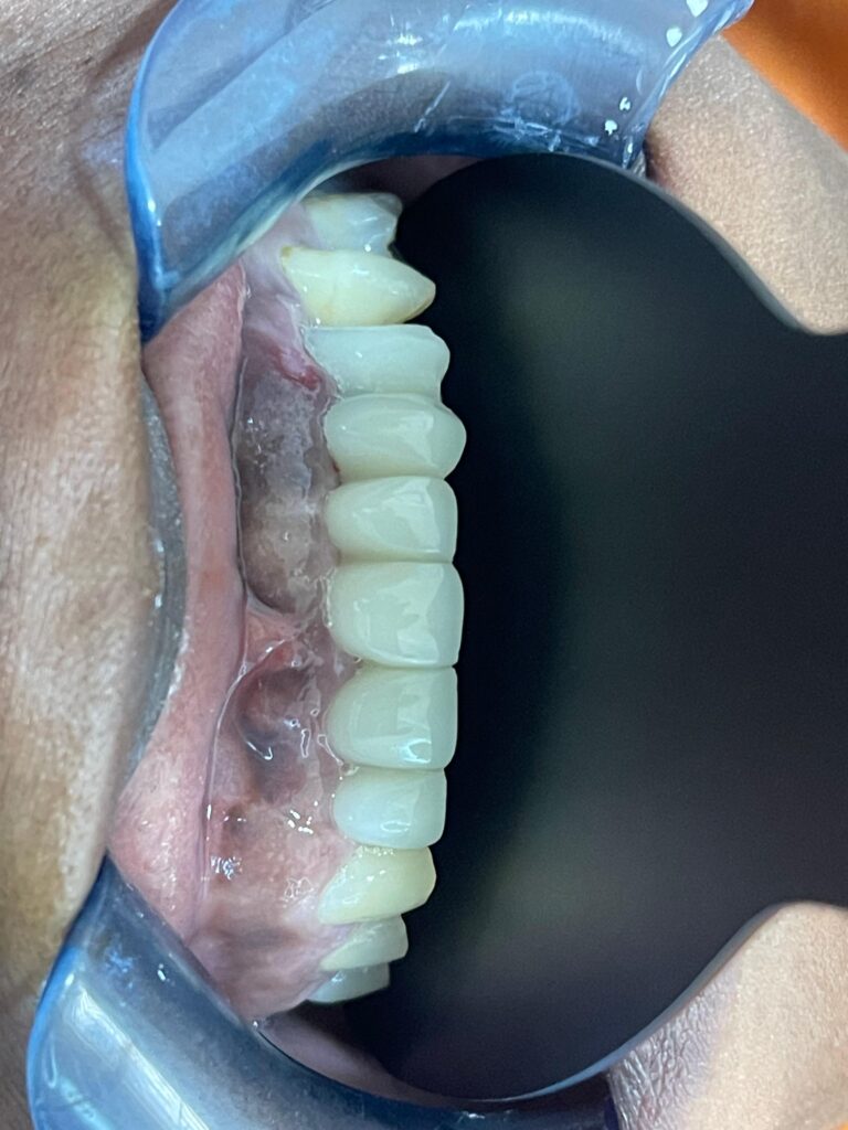 Vista intraoral del resultado final del tratamiento con implantes dentales