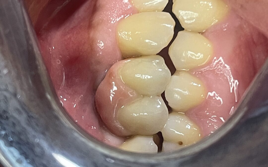 Implantes dentales — Caso 2