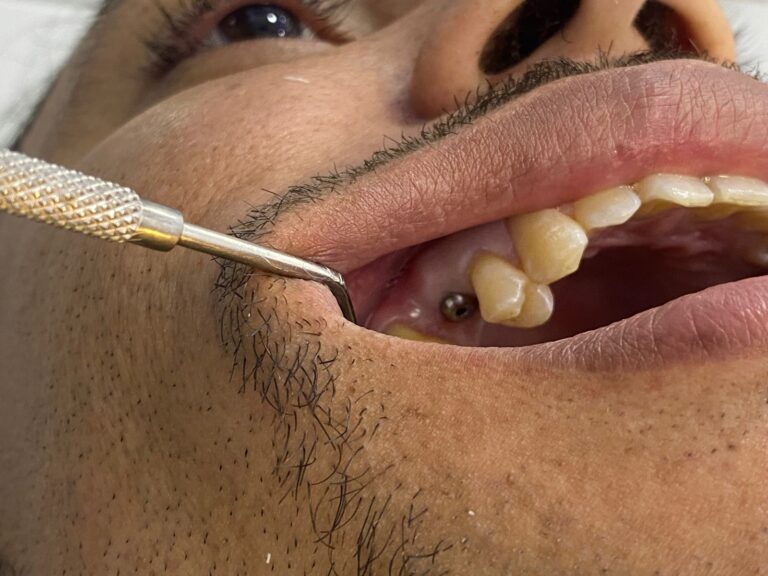 Diente ausente antes de la colocacion del implante dental en la clinica del Dr. Ramses Gonell