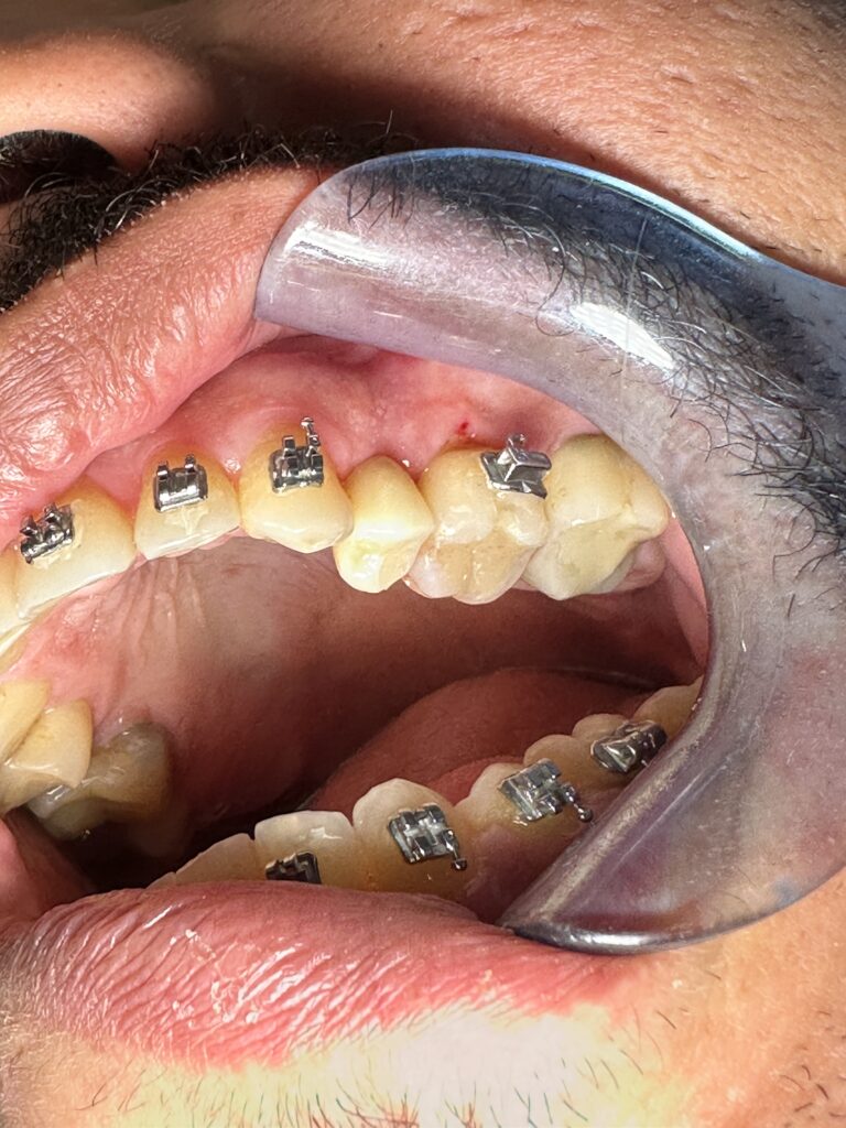 Vista intraoral actual del paciente, con el implante en funcion y la ortodoncia en curso