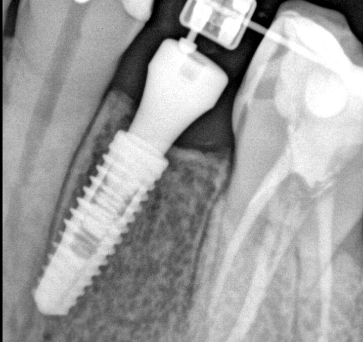 Implantes dentales — Caso 3