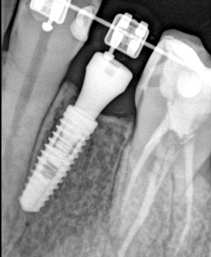 Radiografia del implante dental integrado en el hueso, junto a un bracket de ortodoncia