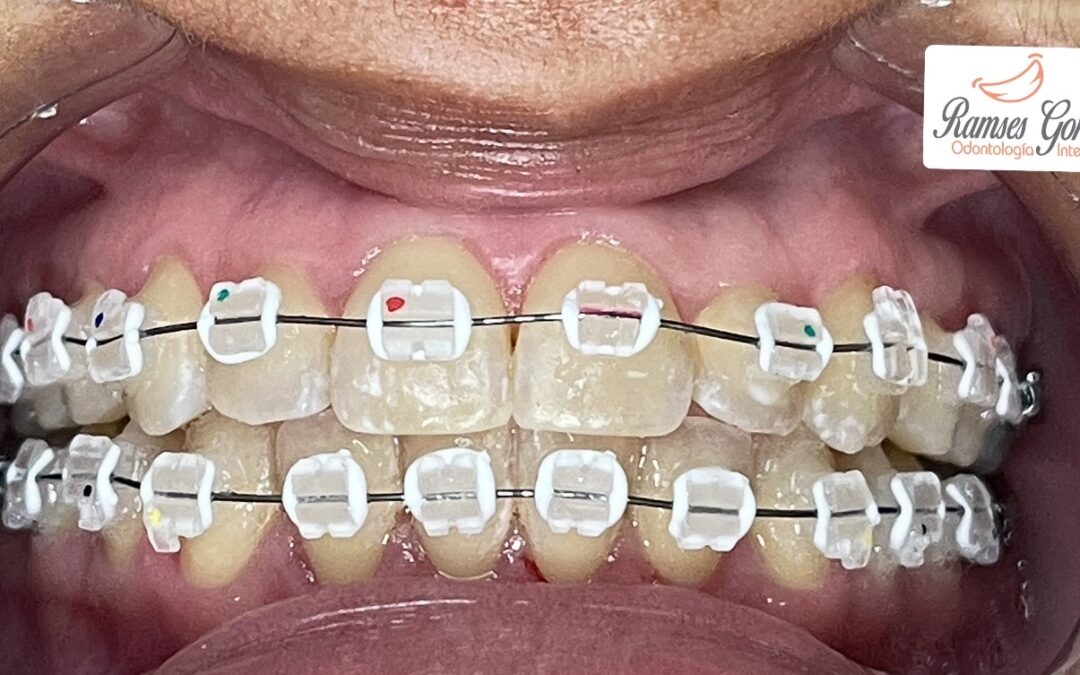 Brackets de zafiro