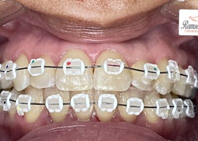 Brackets de zafiro Brackets de zafiro colocados en los dientes de un paciente de la clinica del Dr. Ramses Gonell en Santiago