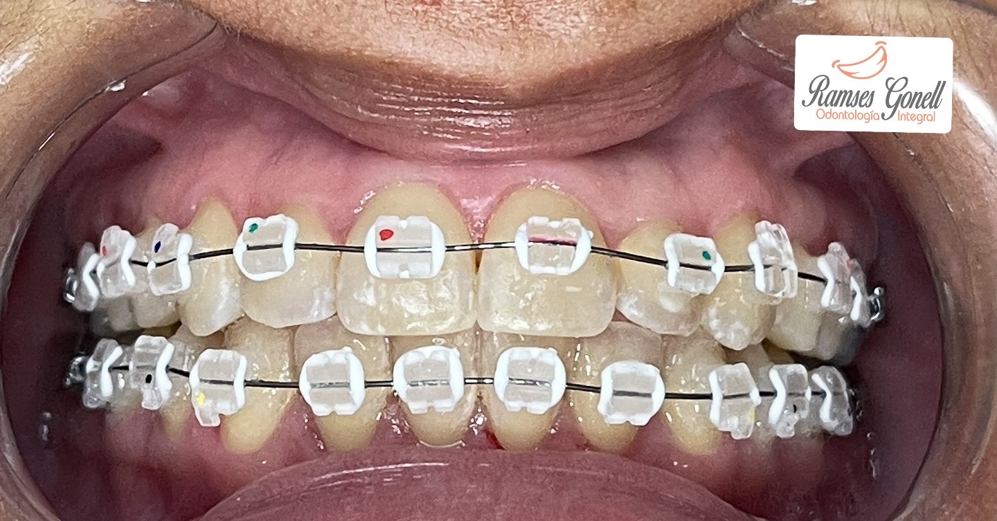 Brackets de zafiro colocados en los dientes de un paciente de la clinica del Dr. Ramses Gonell en Santiago