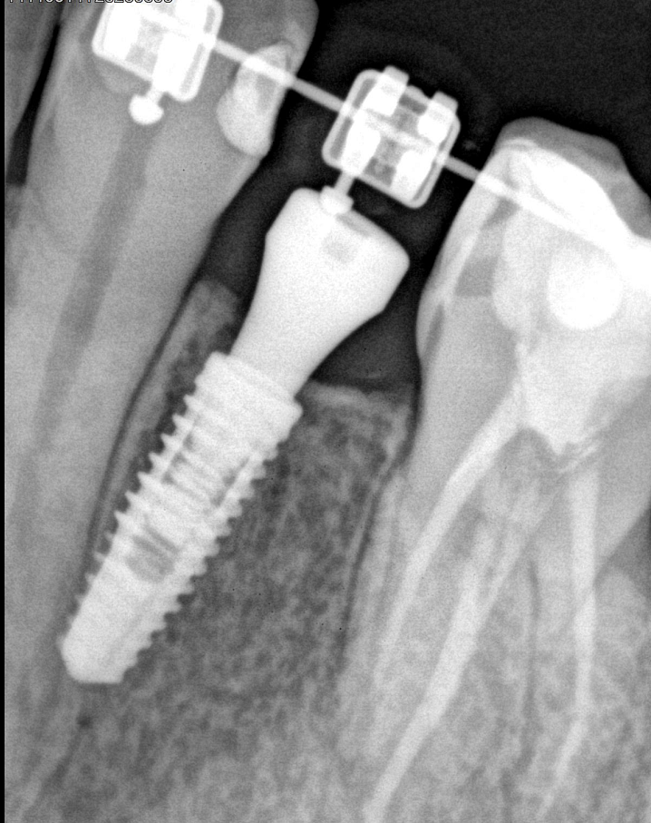 Radiografía de control de un implante dental colocado