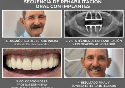 Rehabilitación oral — Caso 1 Secuencia de la rehabilitacion oral con implantes: diagnostico, planificacion, protesis definitiva y resultado final