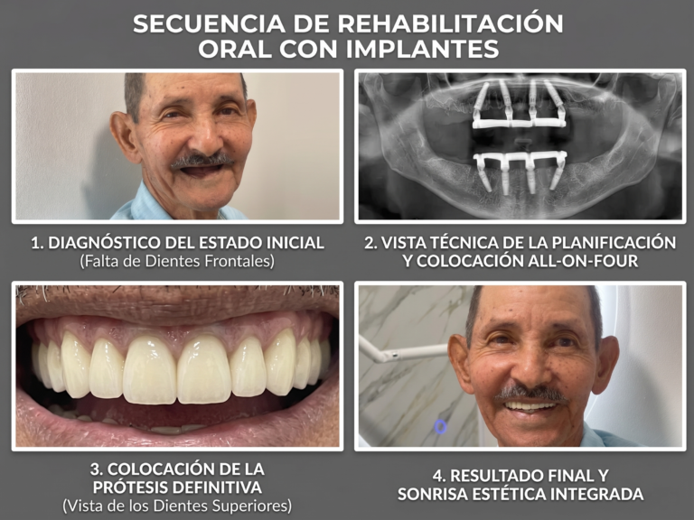 Secuencia de la rehabilitacion oral con implantes: diagnostico, planificacion, protesis definitiva y resultado final