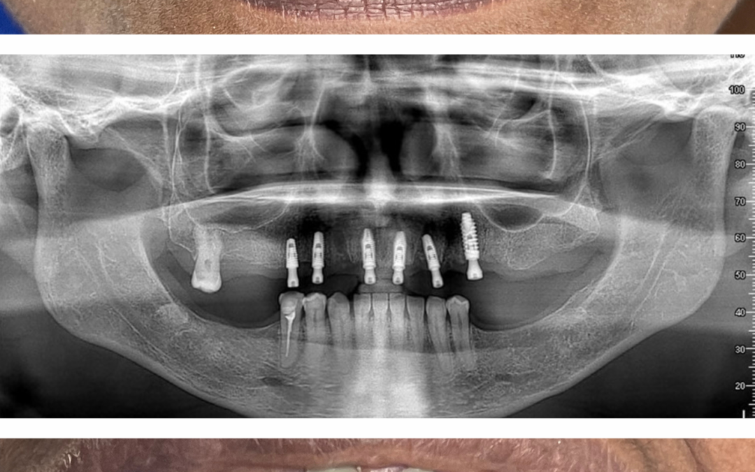 Rehabilitación oral — Caso 4